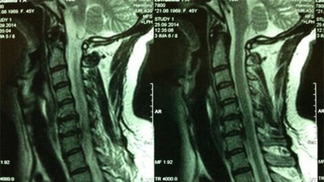 MRI VUN DER CERVIAL DEPARTY