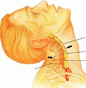 Osteochondrose vun der Halswirbelsäule