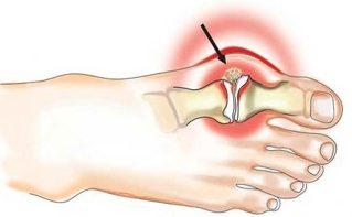 Entzündung vum Gelenks tëscht Daum an Fuß bei Arthritis