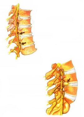 Illustratioun vun Osteochondrose vun der Wirbelsäule