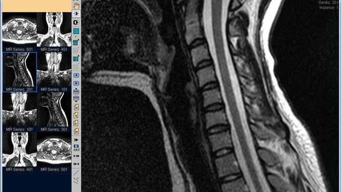 MRI vun der Gebärmutterkierper ass déi bescht Method fir d'Diagnostik vum Hals Schmerz