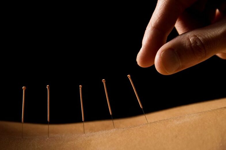 Akupunktur fir Réckschmerzen